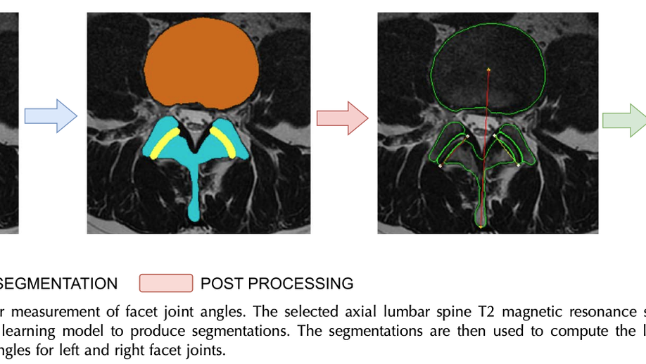 Semiautomatic assessment of facet tropism from lumbar spine MRI using deep learning: a Northern Finland Birth Cohort study