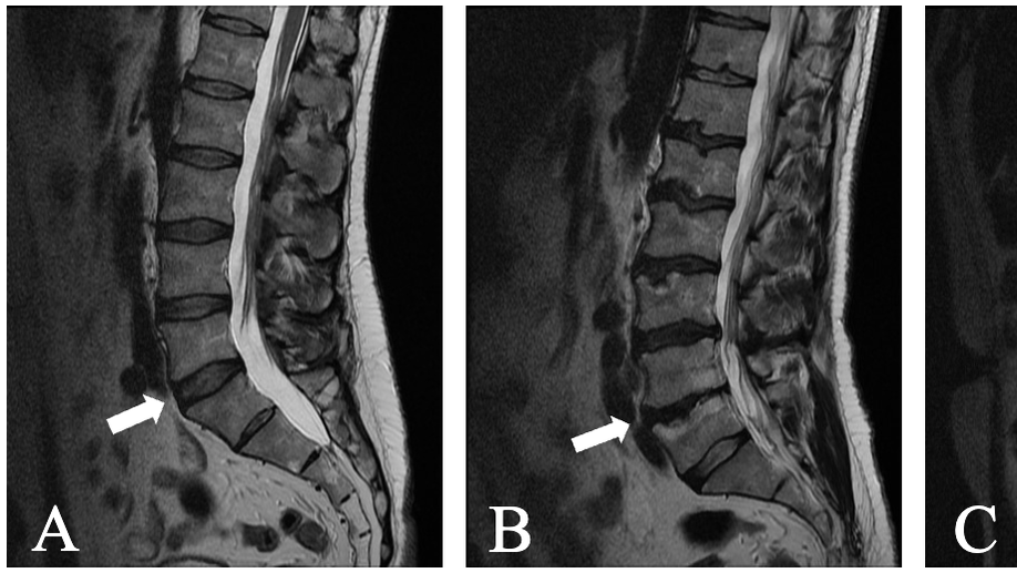 External validation of SpineNet, an open-vsource deep learning model for grading lumbar disk degeneration MRI features, using the Northern Finland Birth Cohort 1966